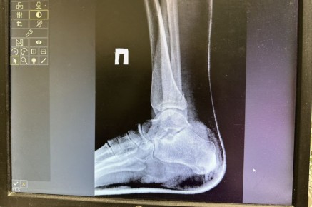 Жительницу Чусового осудили за сломанные ноги сожительницы бывшего мужа