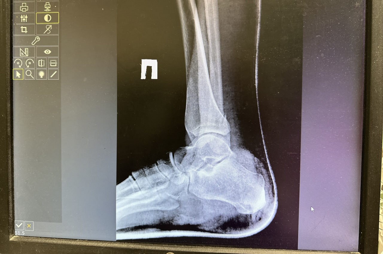 Жительницу Чусового осудили за сломанные ноги сожительницы бывшего мужа